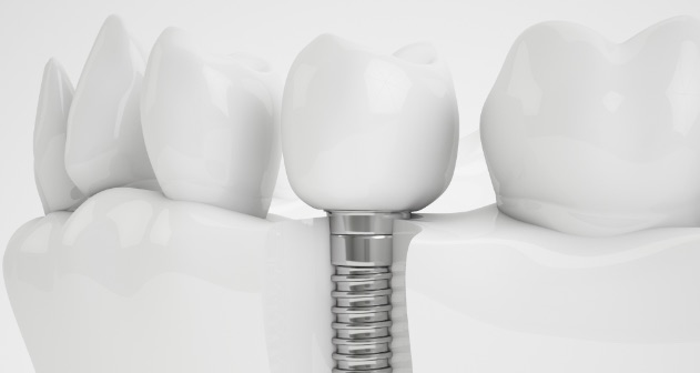 Dentista per bambini a Fondi | Implantologia | Regno Dei Dentini